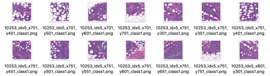 Breast Cancer datasets visualization